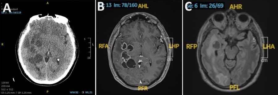 Spain case report: Brain lesions initially suspected as metastatic cancer caused by pork tapeworm