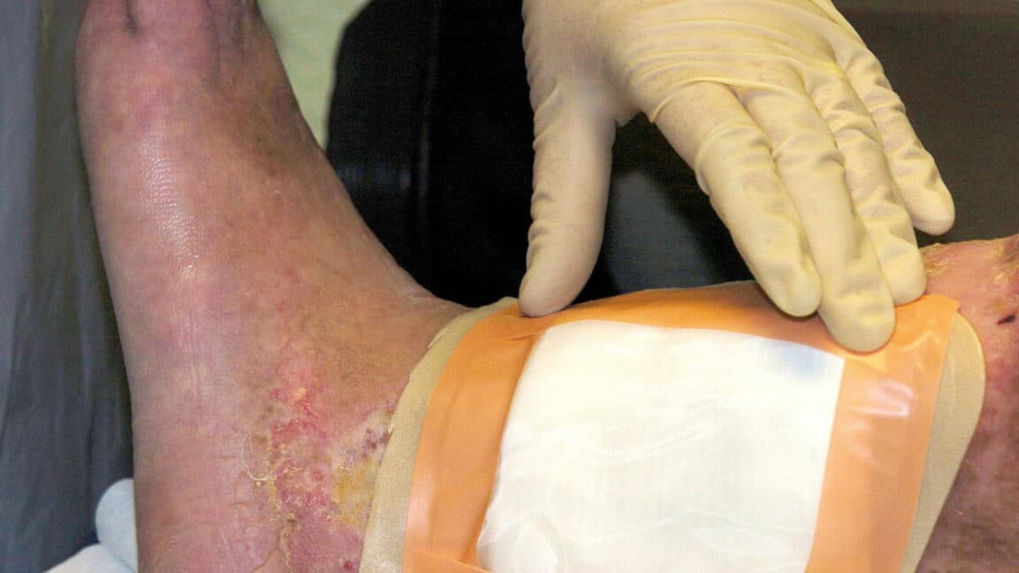FDA clears second fly species for maggot wound therapy, expanding biosurgery options